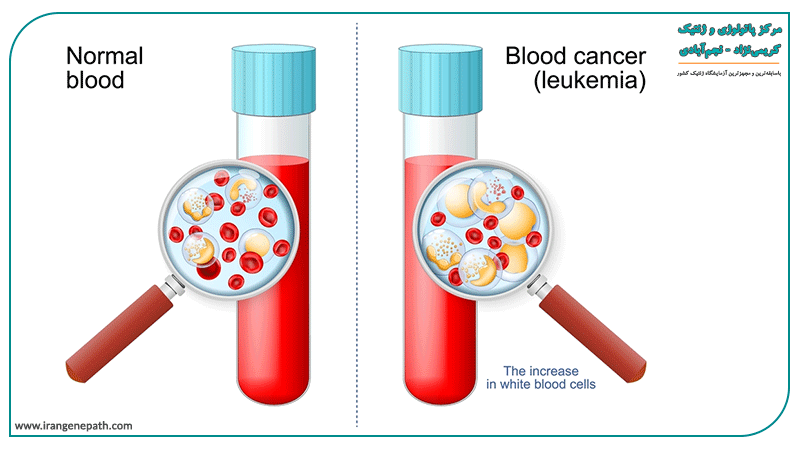 بررسی ژنتیکی انواع سرطان خون