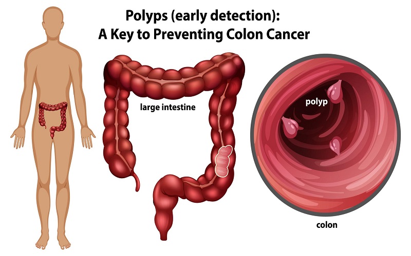 روش‌های تشخیص سرطان روده بزرگ