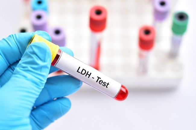 آزمایش LDH چیست و بالا بودن آن در خون چه معناست؟