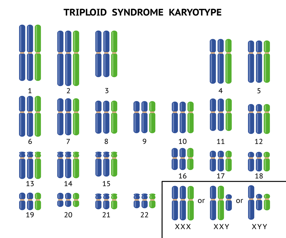 تریپلوییدی (Triploidy) چیست؟