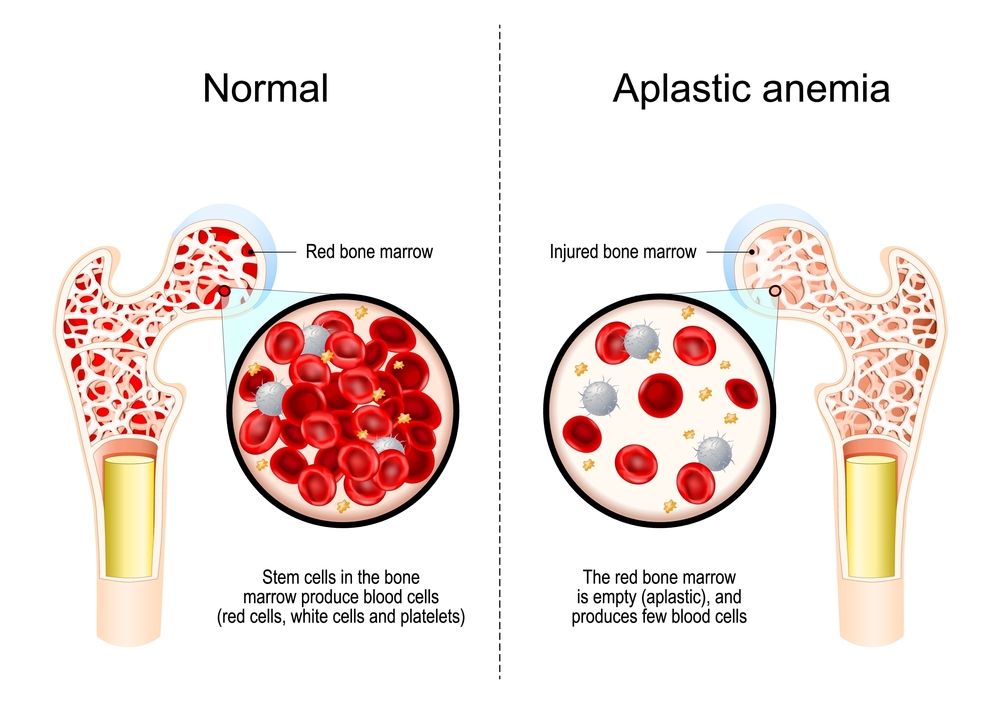 کمخونی آپلاستیک (Aplastic Anemia) چیست؟