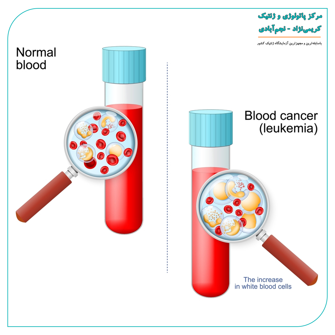 آزمایشهای مرتبط با انواع سرطانهای خون