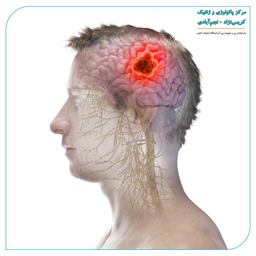 بررسی ژنتیکی تومورهای مغزی و سرطانهای سیستم عصبی